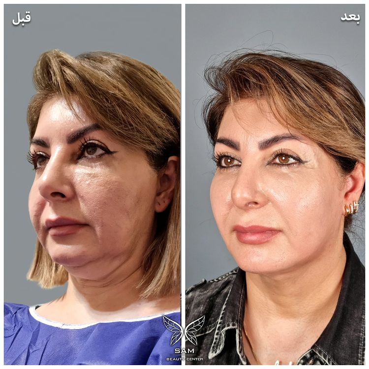 عکس قبل و بعد ساکشن غبغب1