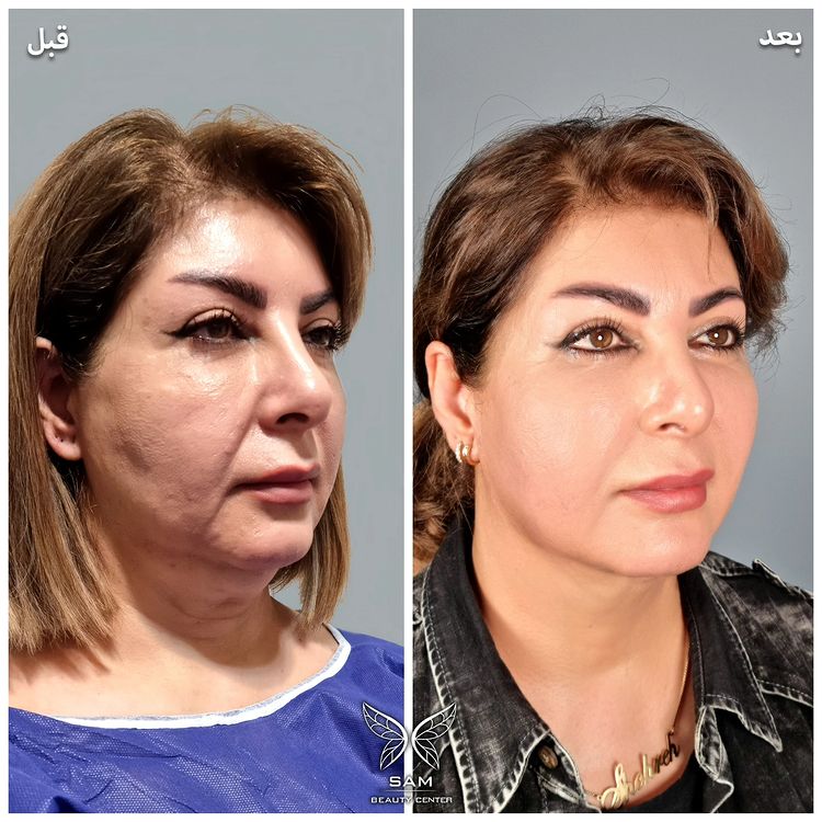 عکس قبل و بعد ساکشن غبغب