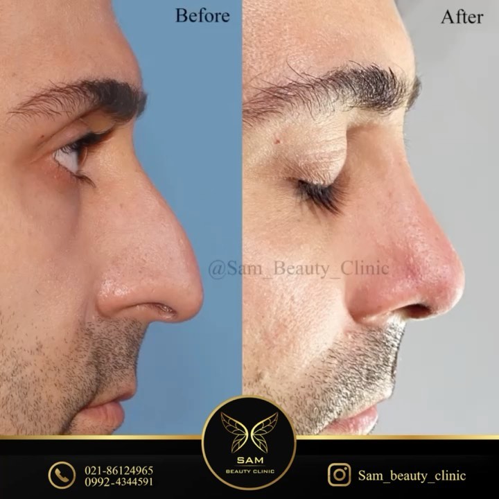 جراحی بینی طبیعی در کلینیک زیبایی سام - کلینیک زیبایی سام